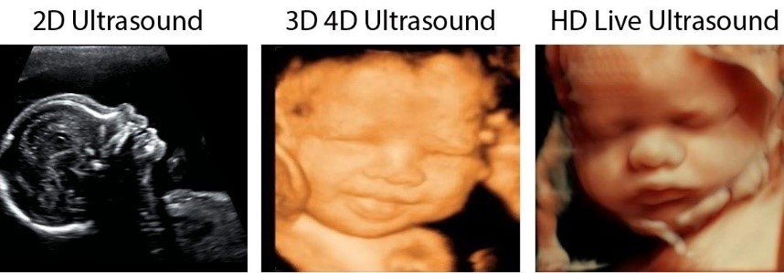 3D 4D Ultrasound picture Baby ultrasonic photo pregnancy image personalized 